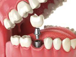 Dental Implants Bhiwadi